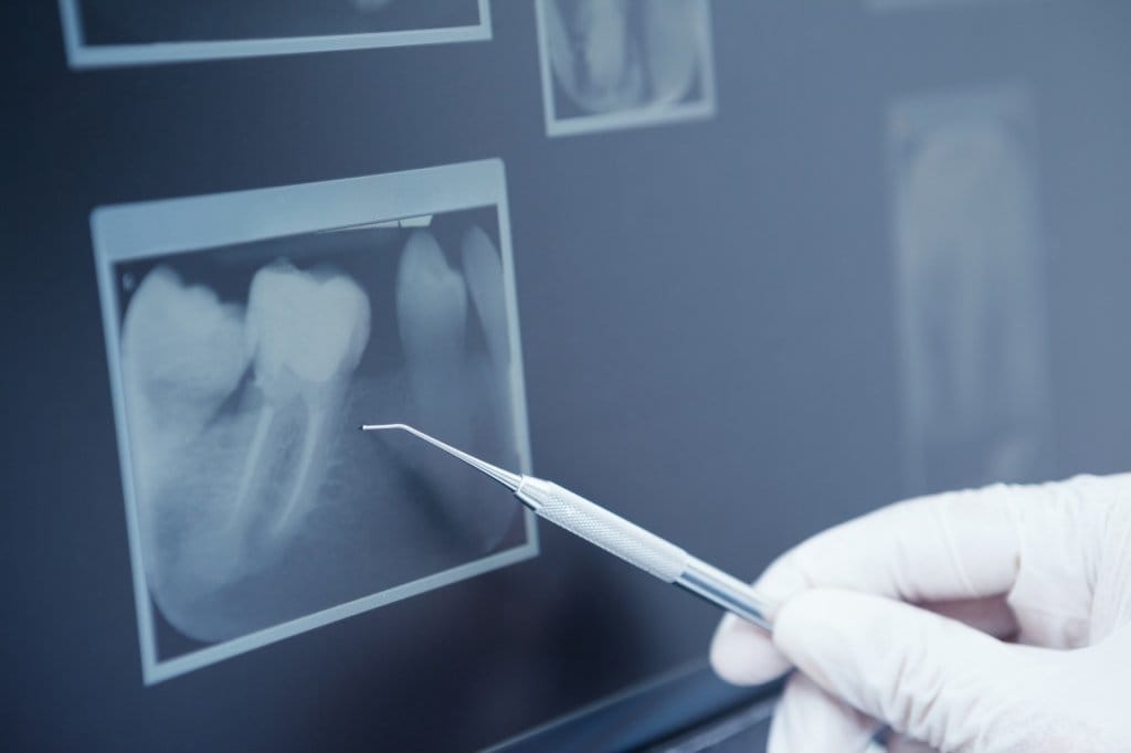 Endodonzia - Alfa Studio Dentistico - Come capire se il dente del giudizio va tolto