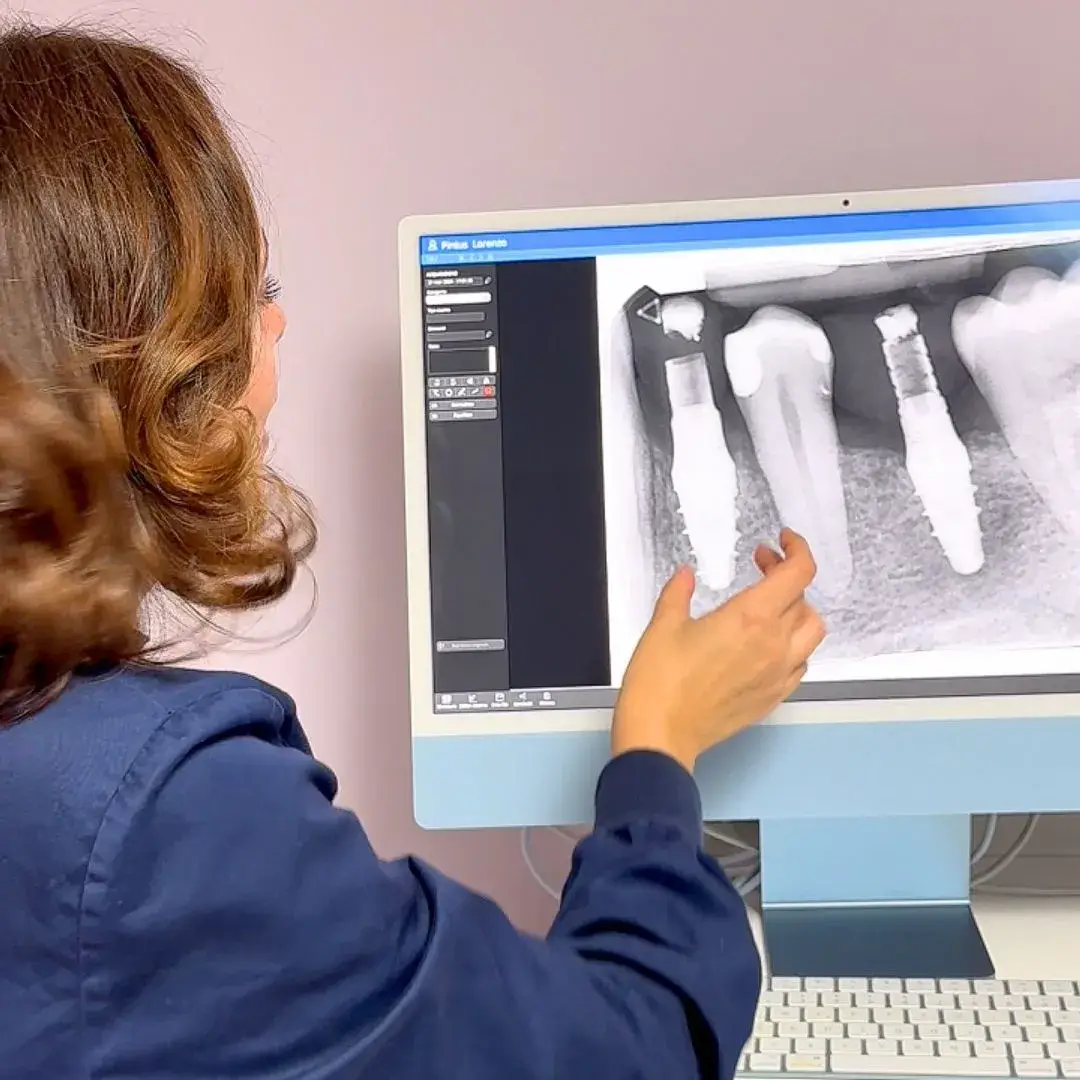 quanto dura un impianto dentale